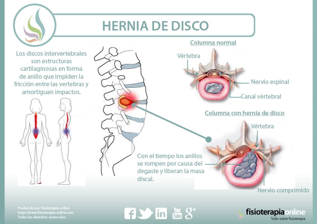 cuenca Andrew Halliday Estación de policía Hernia discal lumbar: Qué es, causas, síntomas, tratamiento y consejos |  FisioOnline