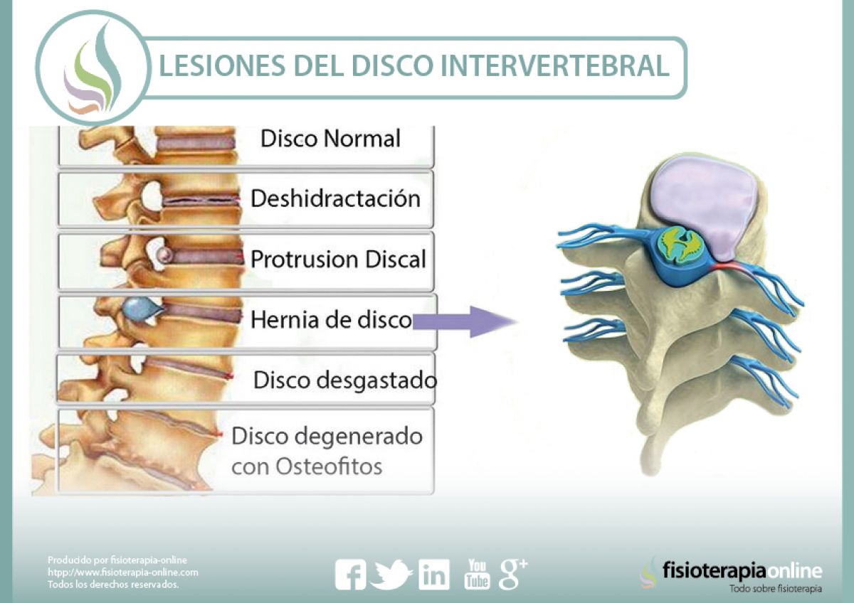 Lesiones más frecuentes del disco intervertebral