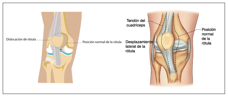 Luxación de rótula 