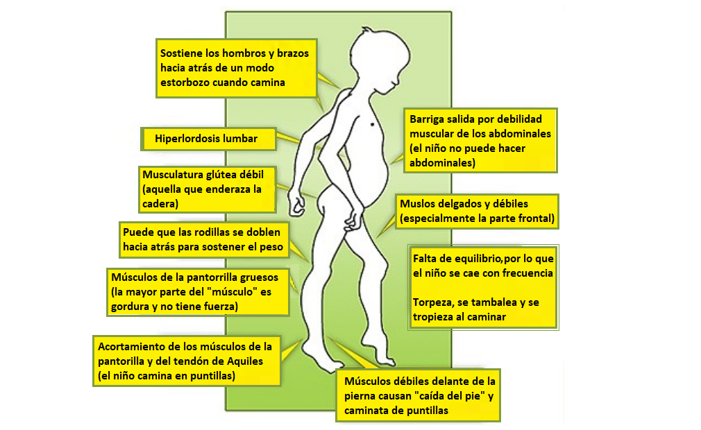 Dificultad para caminar (marcha en la distrofia de Duchenne)