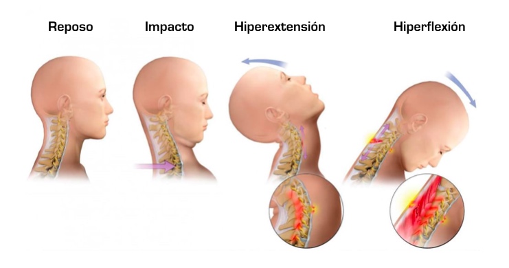 Mecanismo de la lesión de esguince cervical