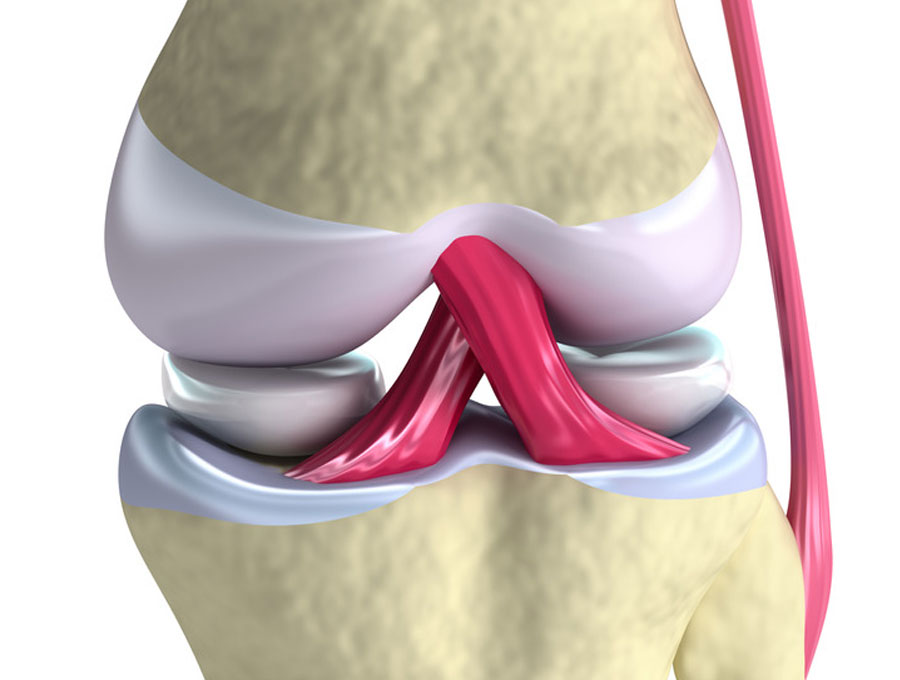 cirugía de trasplante de menisco