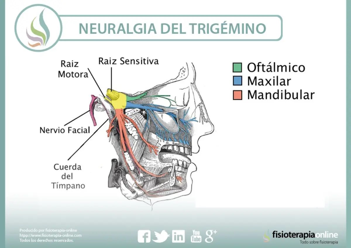 neuralgia del trigémino