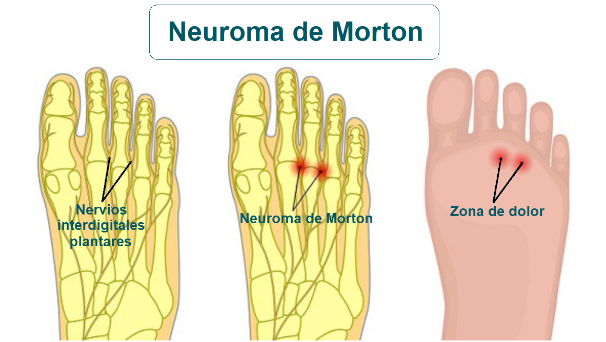 Neuroma de Morton