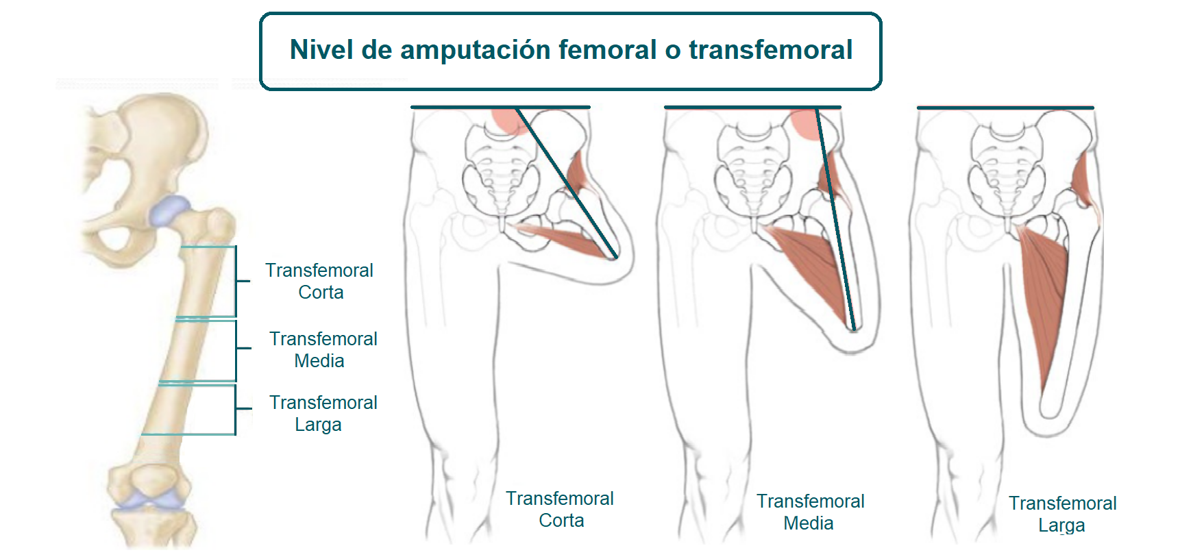 Nivel de amputación femoral o transfemoral