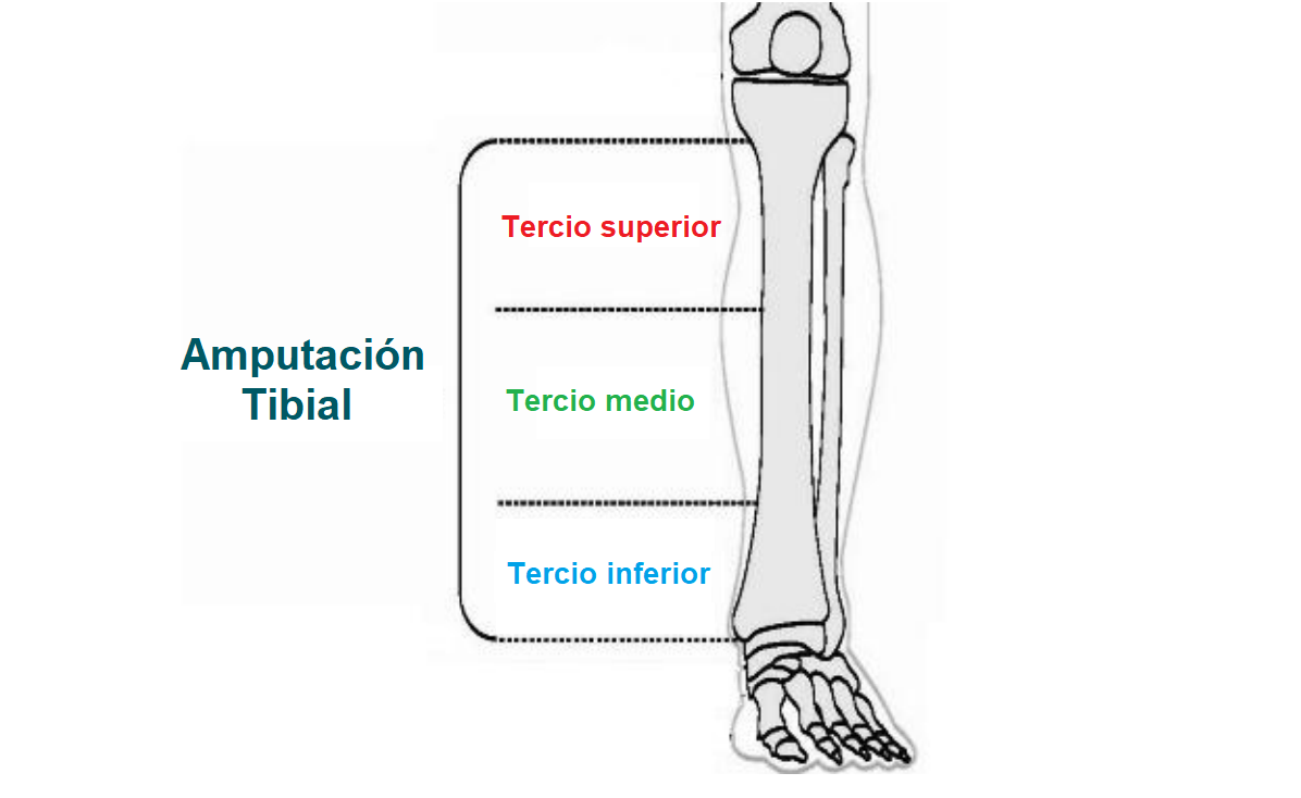 niveles de la amputacion tibial o transtibial