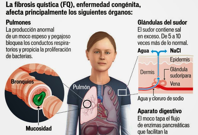 Órganos afectados por la fibrosis quística
