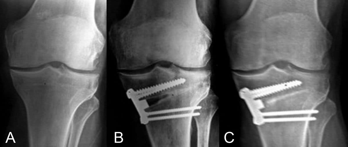 osteotomía tibial