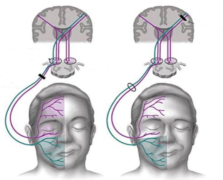 tipos de parálisis facial periférica y central