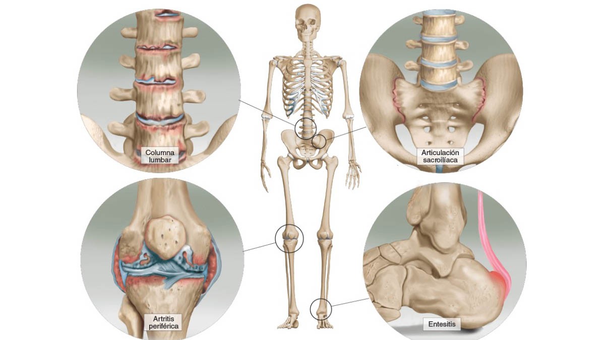 Partes afectadas por la espondilitis anquilosante