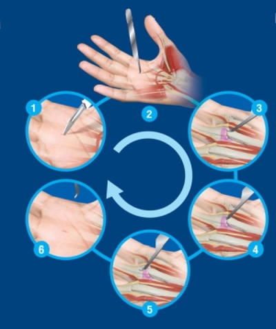 En qué consiste la cirugía del dedo en gatillo o resorte