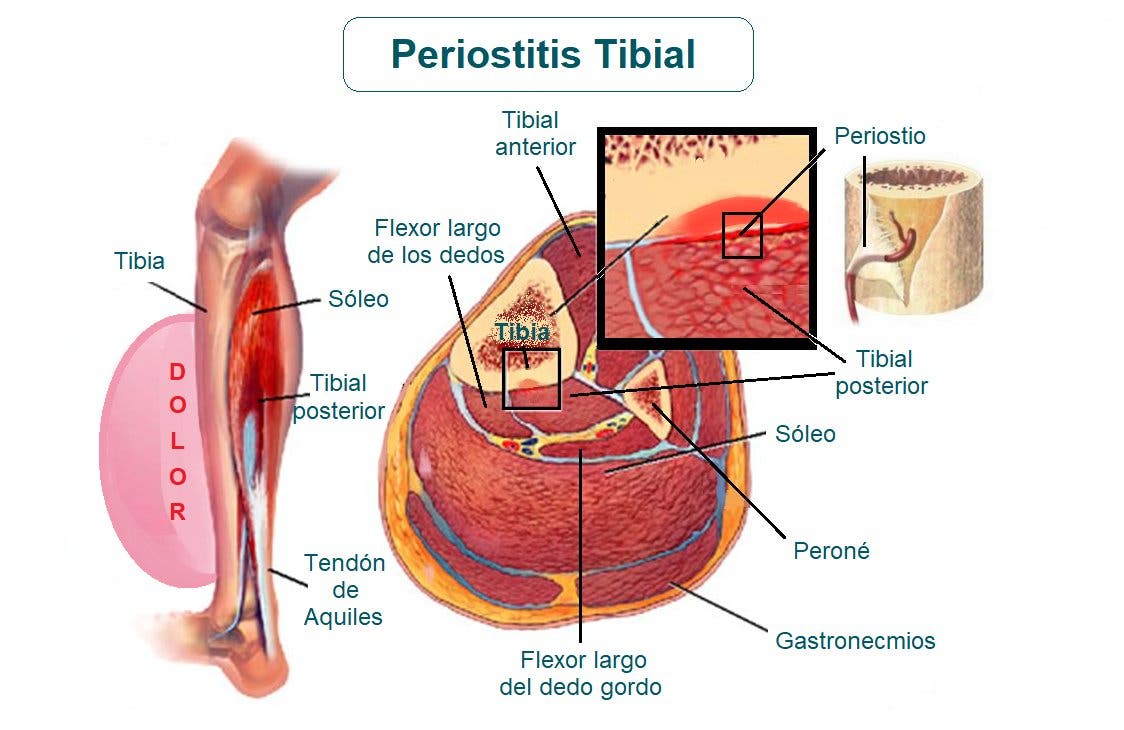 Anatomía de la periostitis tibial