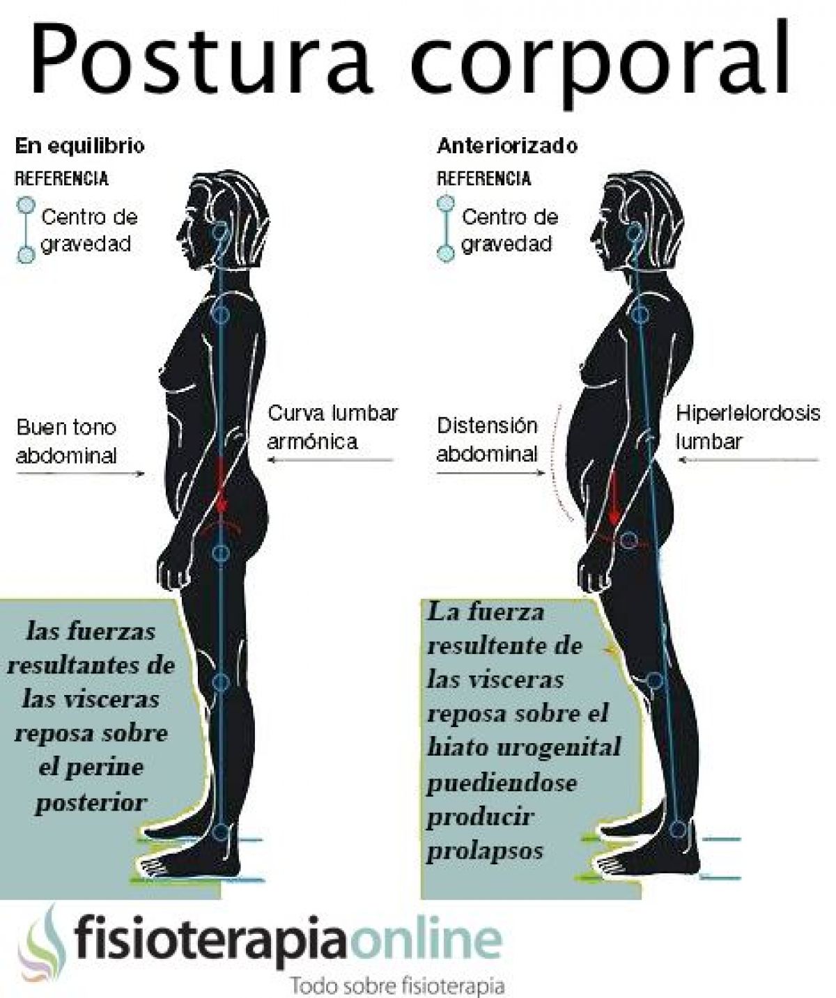postura alterada por la hiperlordosis lumbar