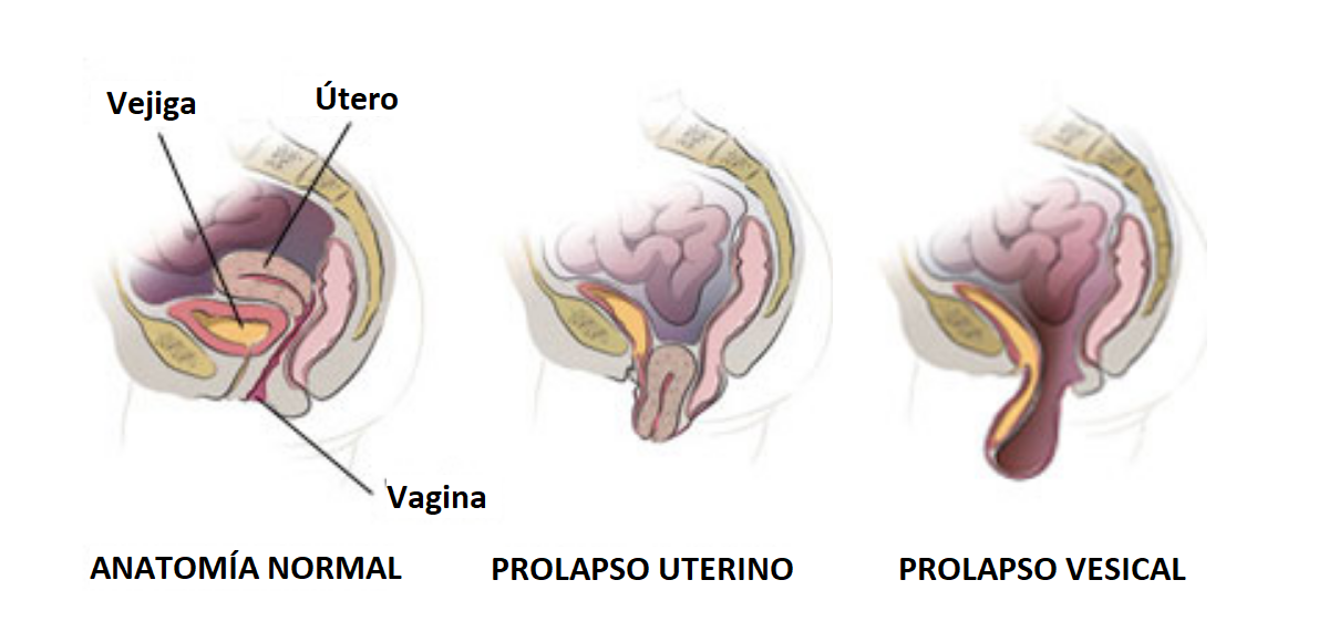 Prolapso uterino y vesical