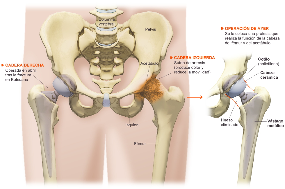 Prótesis de Cadera 