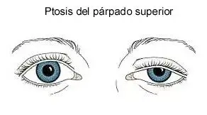 ¿Qué es una Ptosis palpebral? Causas, síntomas y tratamiento fisioterapéutico