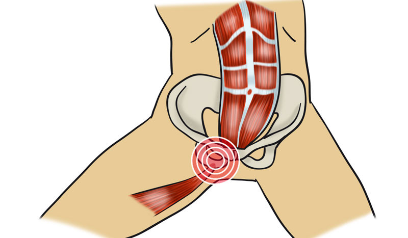 cómo diagnosticar la pubalgia u osteopatía de pubis 