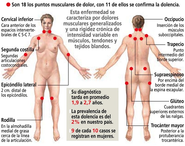 puntos de gatillo en fibromialgia