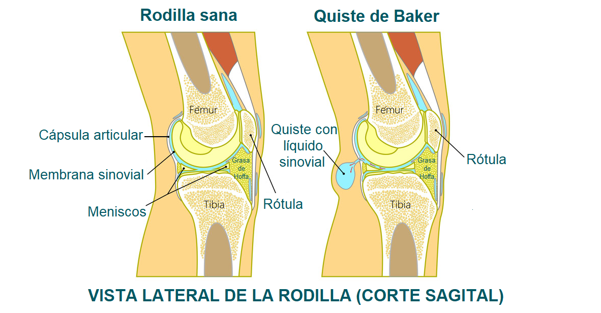 anatomía del quiste de Baker