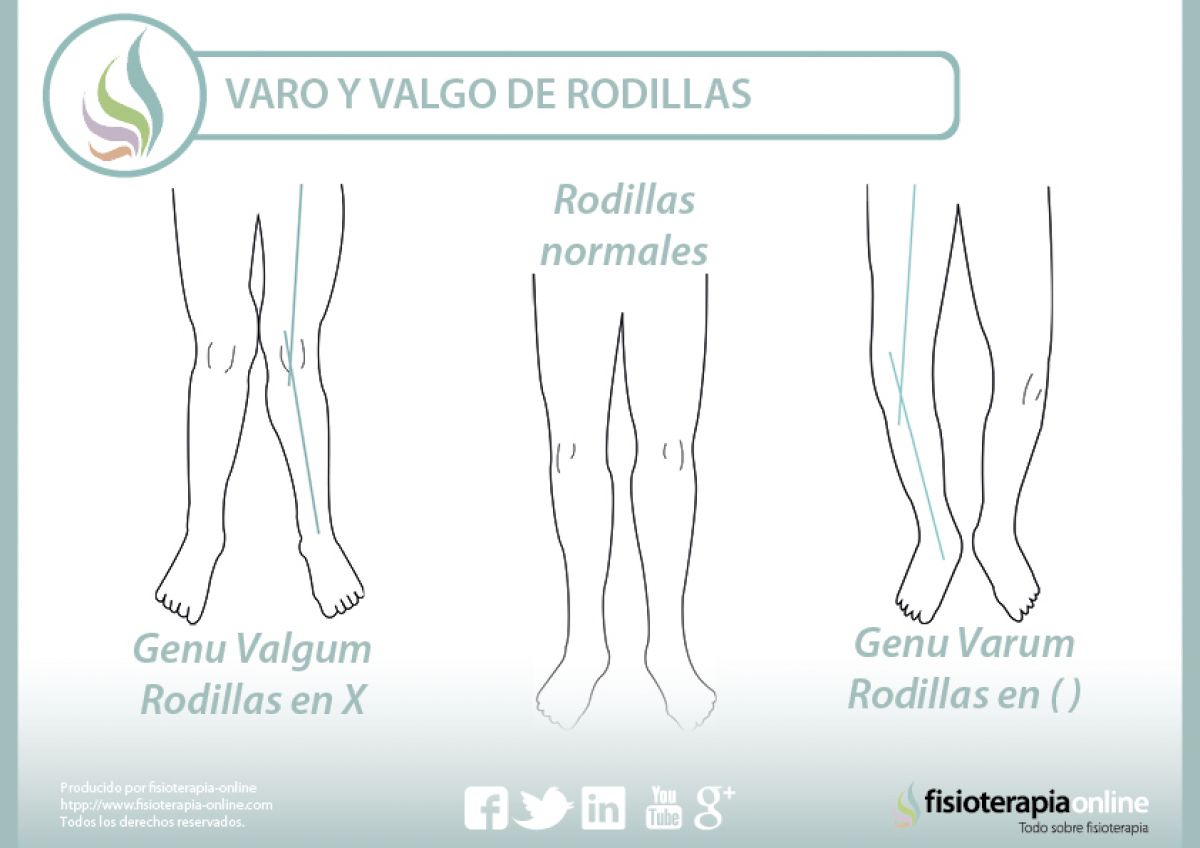 Rodillas valgas y varas