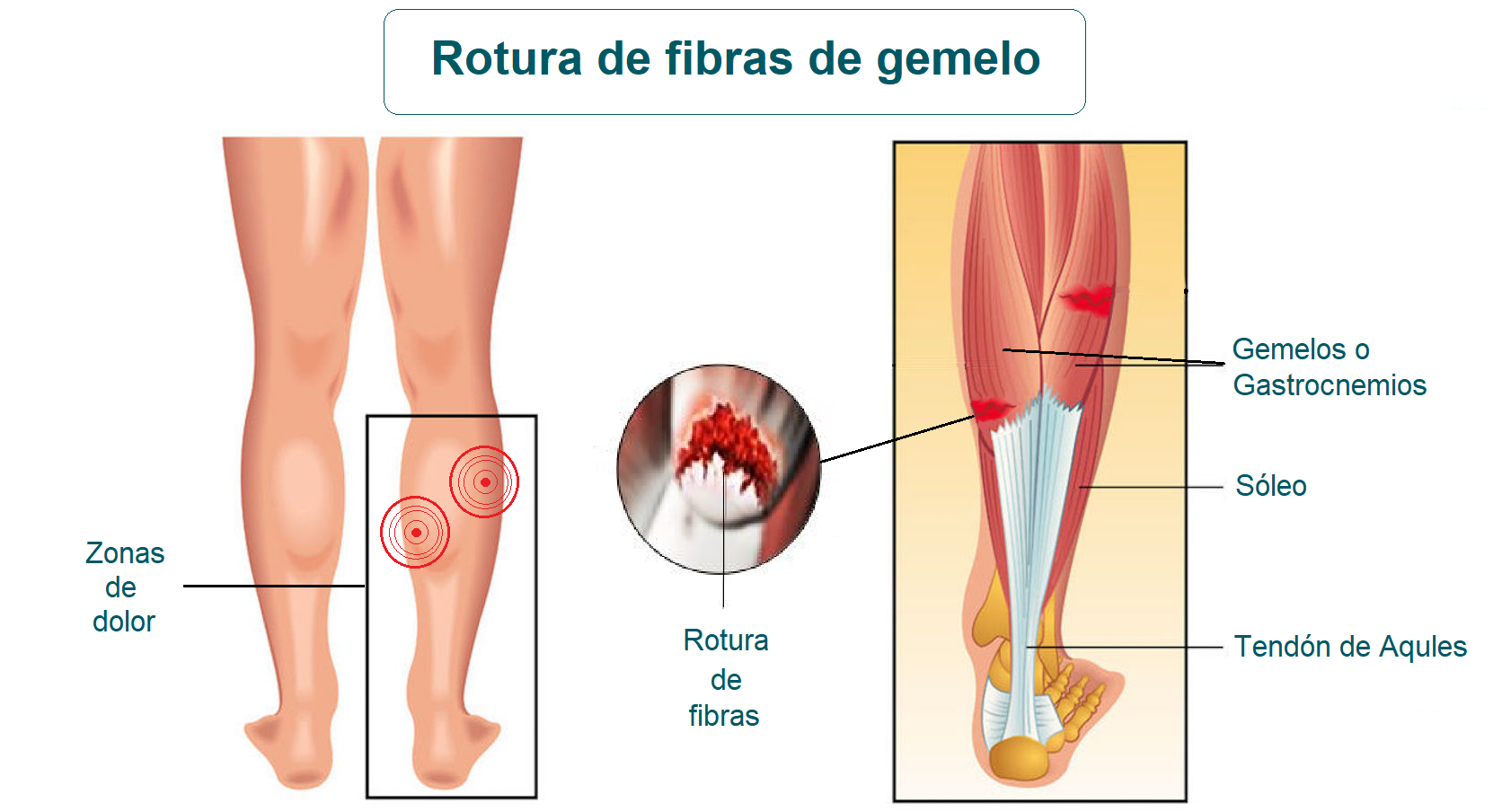 Rotura de fibras de gemelos