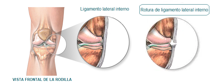 rotura de ligamento lateral interno