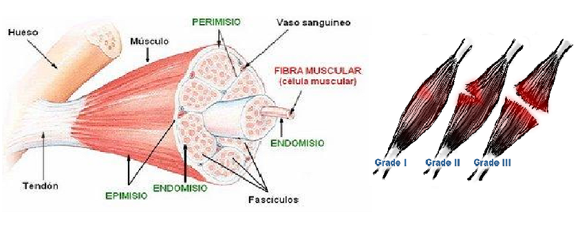 Diagnóstico de la rotura muscular 