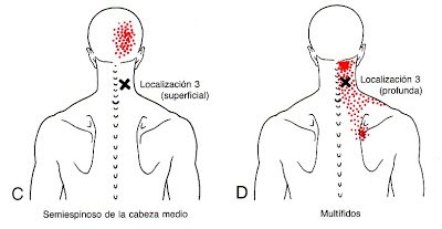 Dolor de cabeza nuca mareos