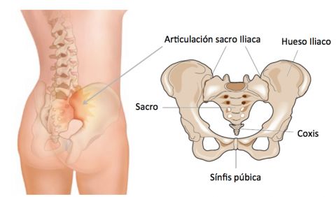 Tratamiento para el dolor sacro iliaco o sacro-ileÃtis