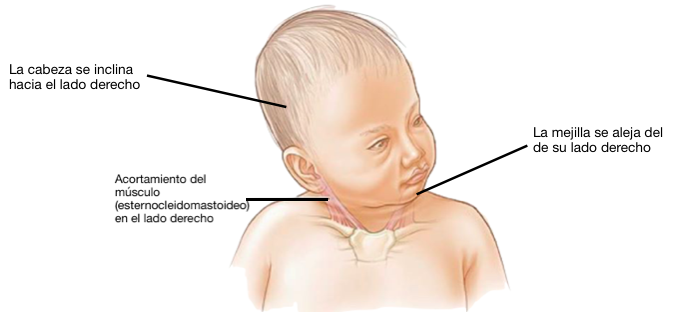 Signos de la tortícolis congénita
