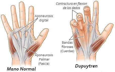 sindrome de dupuytren