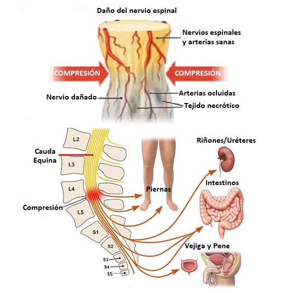 síndrome de la cola de caballo o cauda equina