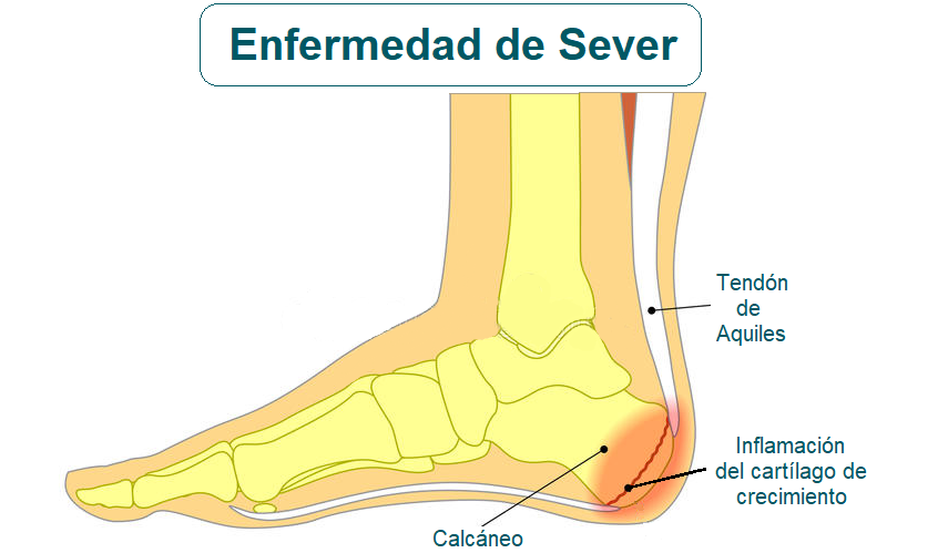 Síndrome o enfermedad de Sever