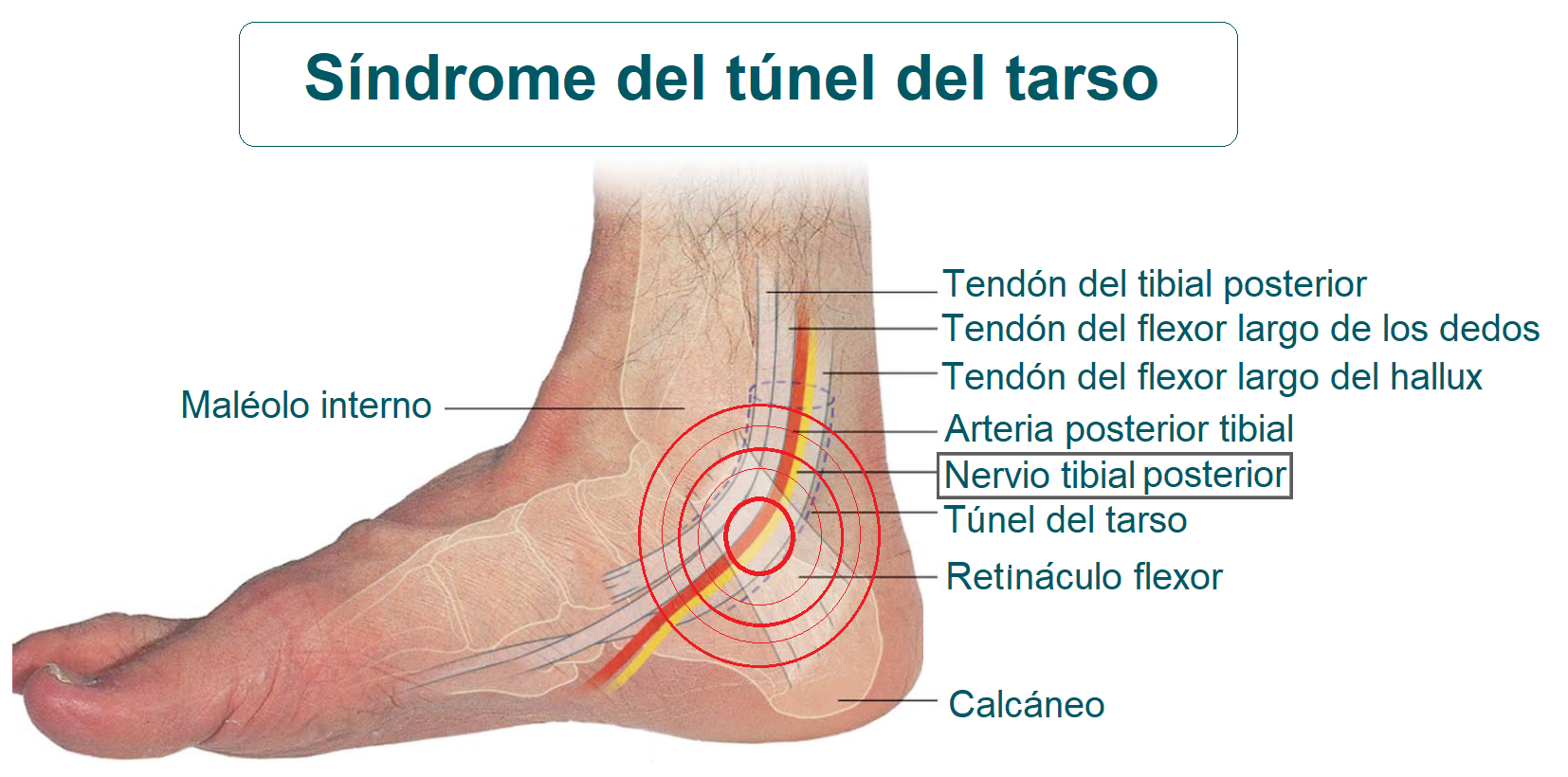 Anatomía del síndrome del túnel del tarso