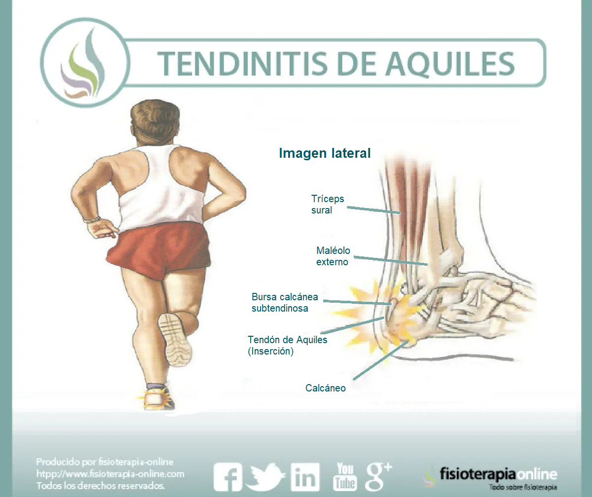 Tendinitis de Aquiles o Aquílea