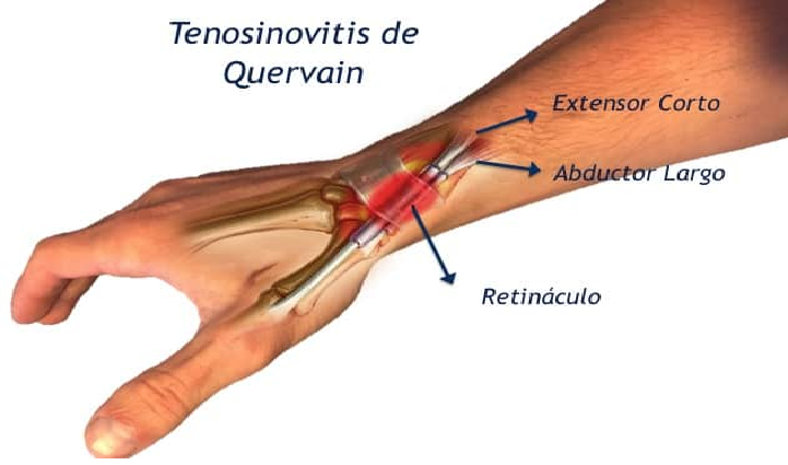 tendinitis de de quervain