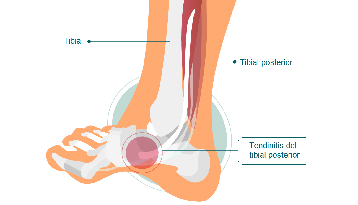 tendinitis de tibial posterior