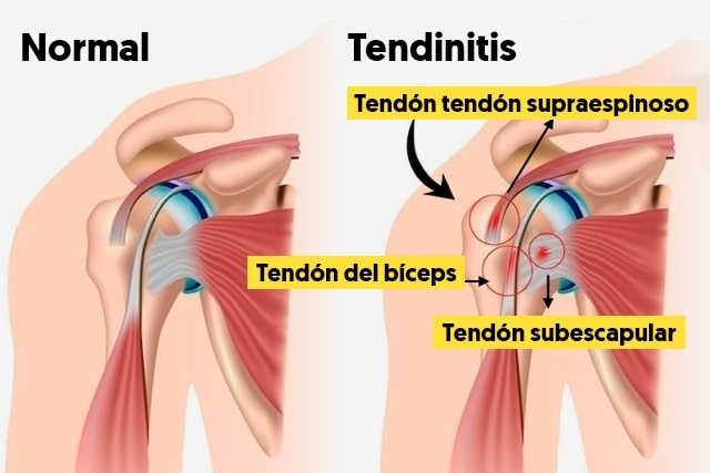 Tendinopatía de hombro