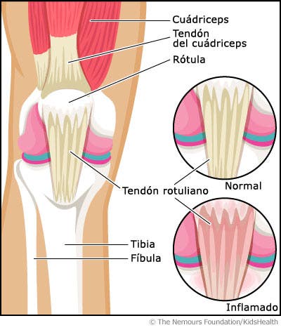 tendón rotuliano y el tendón cuadricipital