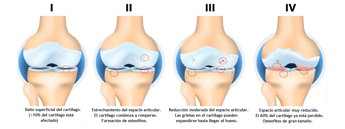 Se puede curar la artrosis de rodilla