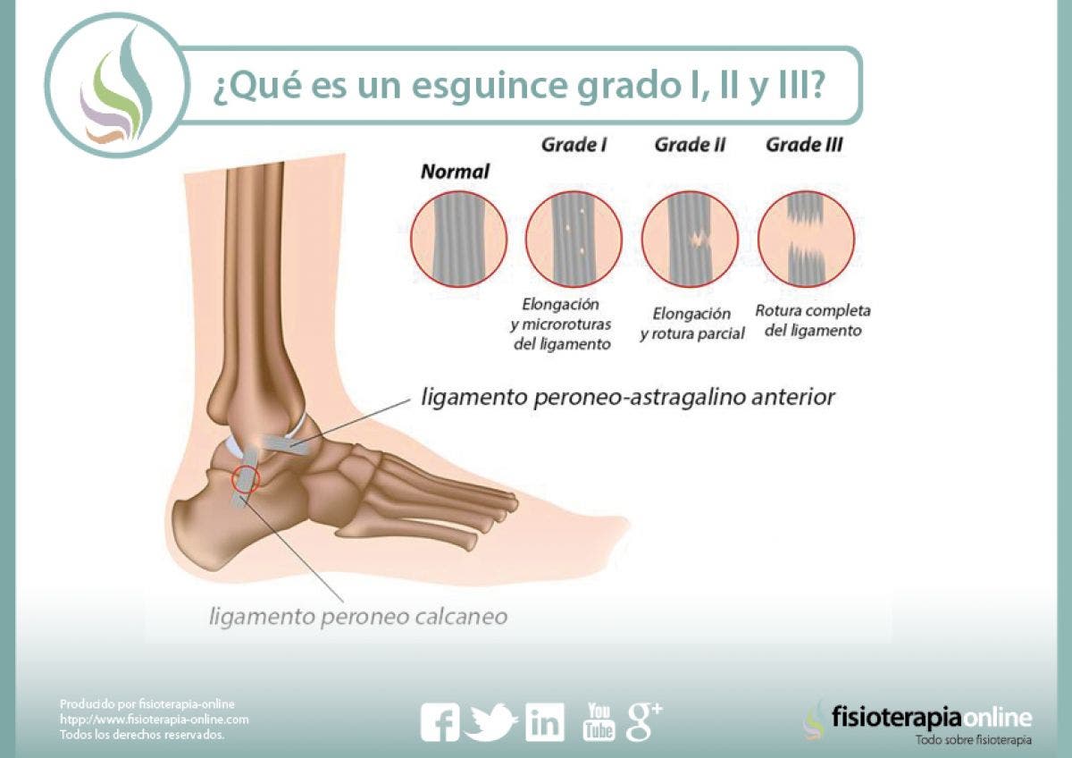 Clasificación del esguince de tobillo