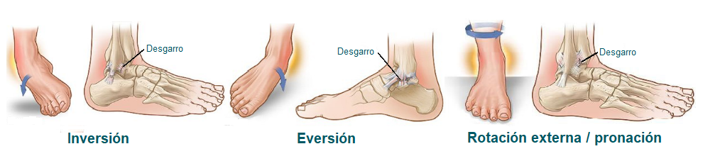 Tipos de esguinces de tobillo según mecanismo de lesión