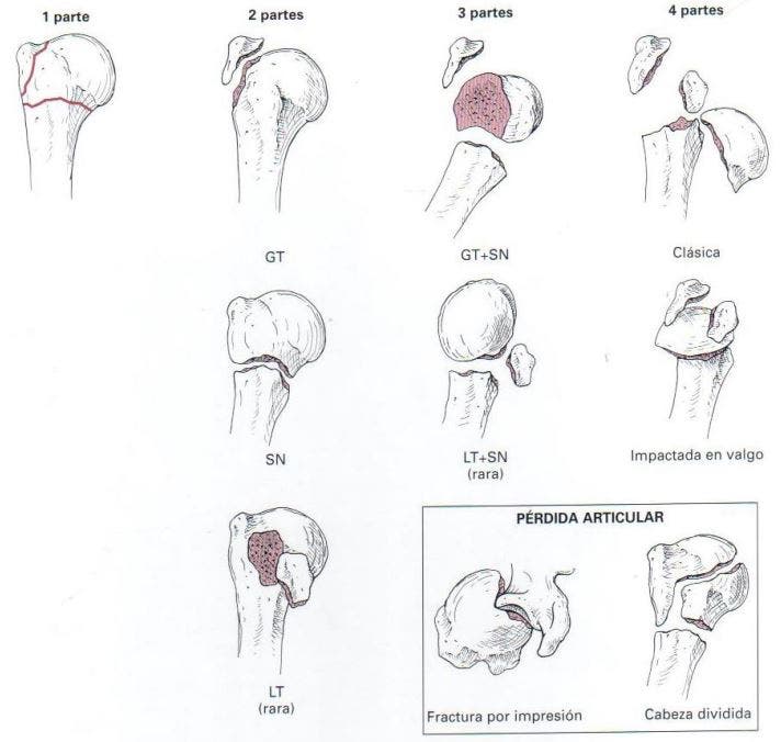 clasificación de fracturas proximales de húmero neer