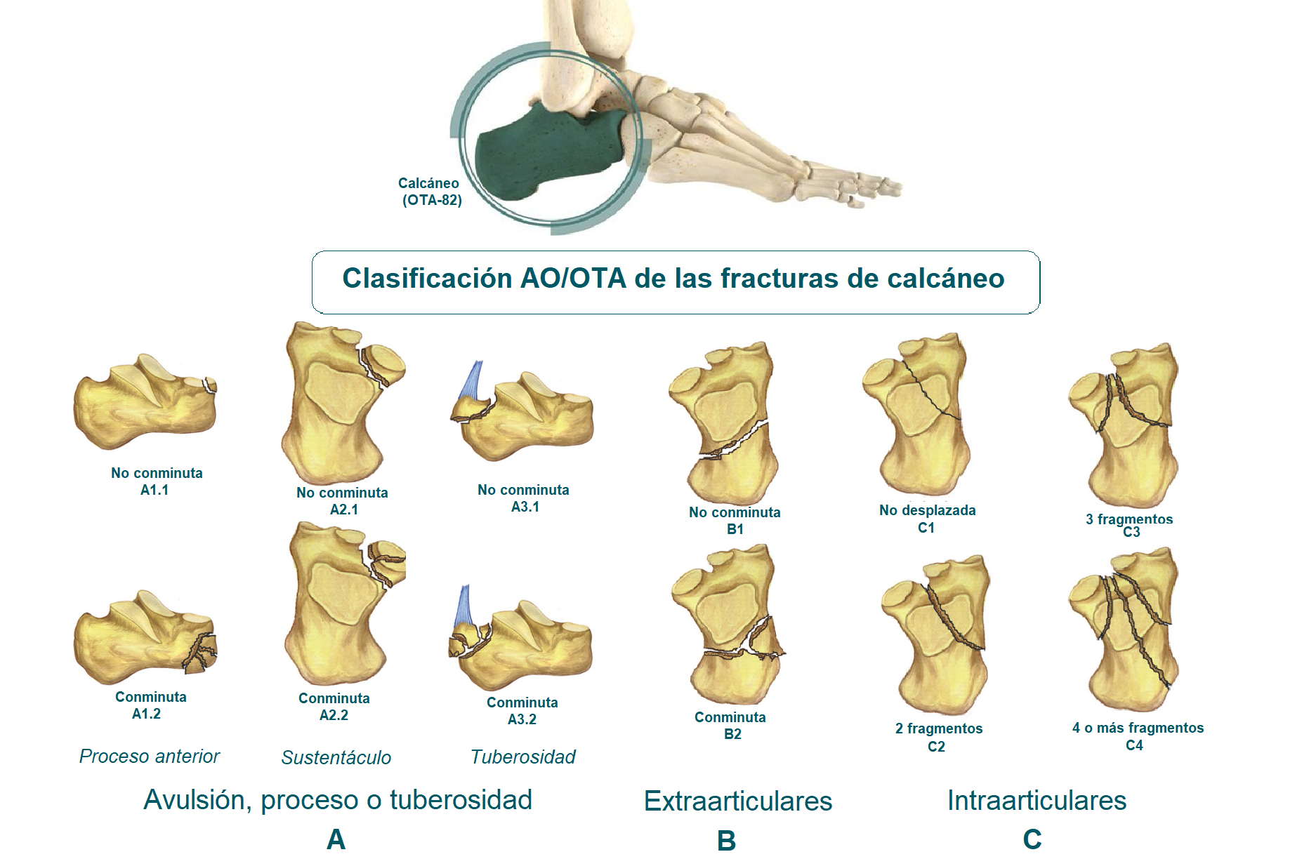 Tipos de fracturas de calcáneo