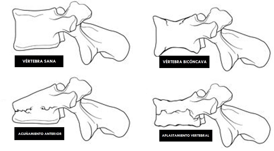 tipos de fracturas vertebrales