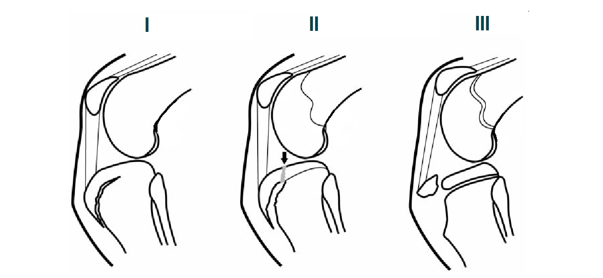 Clasificación del Síndrome Osgood-Schlatter o crecederas