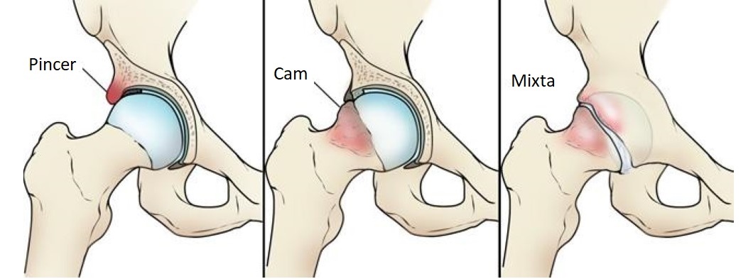 tipos de pinzamientos femoroacetabular cam o pincer