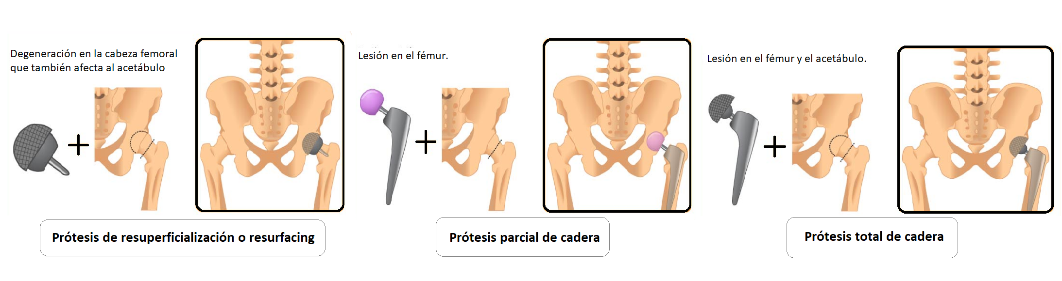 tipos de prótesis de cadera