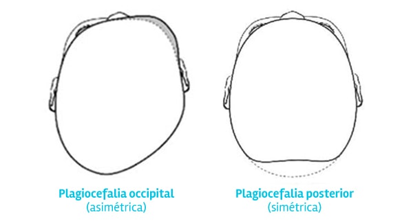 Tipos de plagiocefalia
