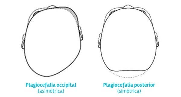 Tipos de plagiocefalia